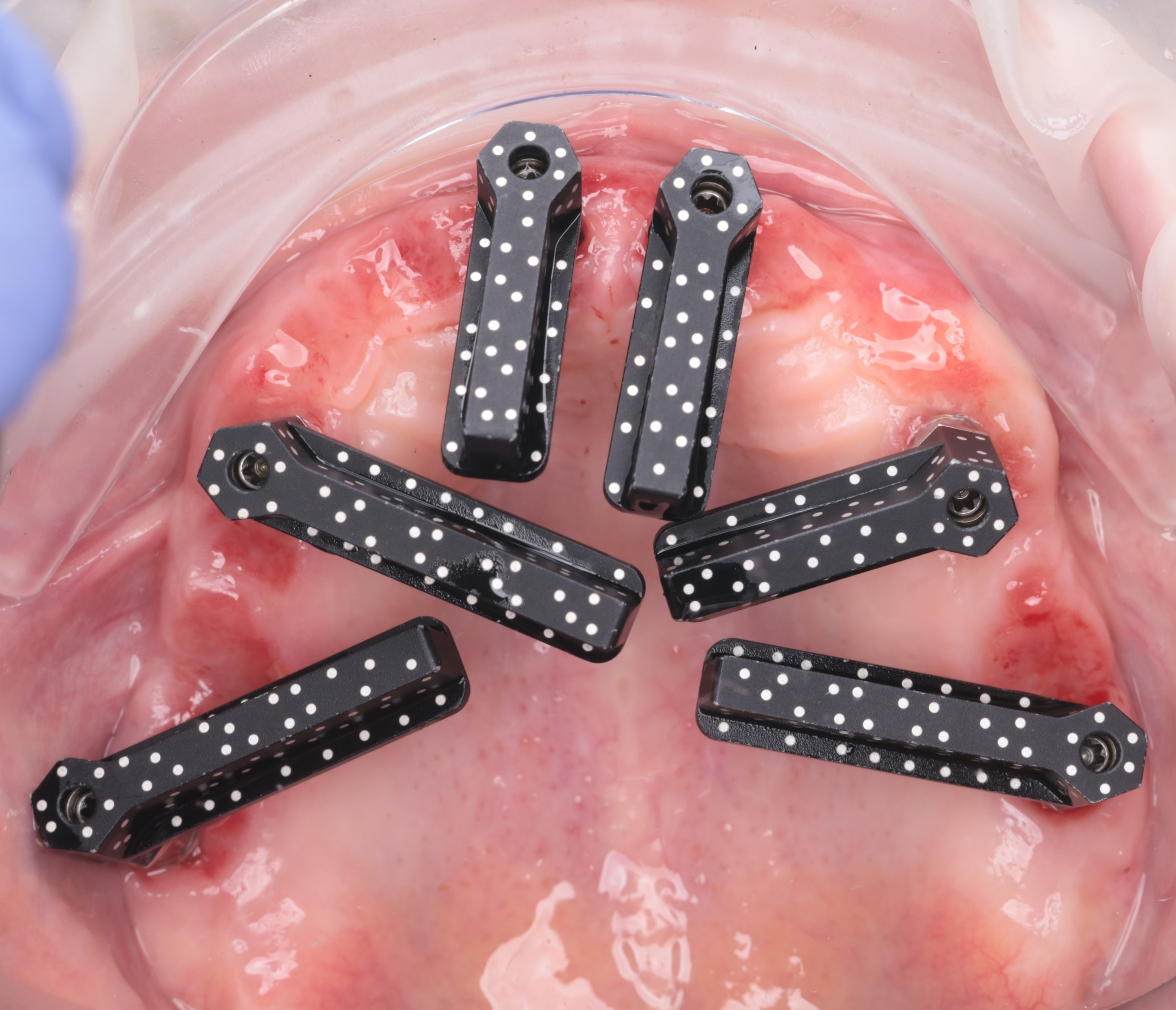 二期上颌扫描杆