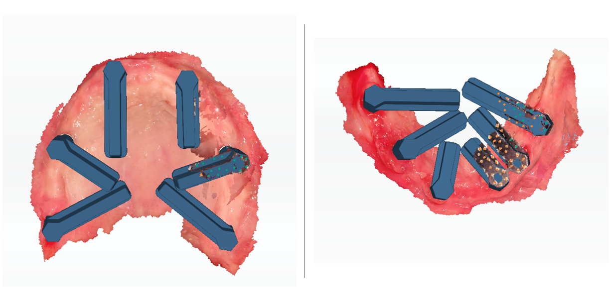 3D digital rendering generated from photogrammetry data showing spatial orientation of dental implants