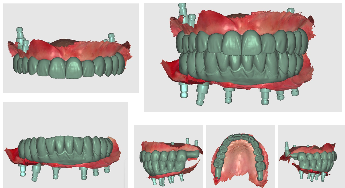 Exocad CAD virtual 3D models of diagnostic digital wax‑up for full‑arch screw‑retained implant‑supported prosthesis