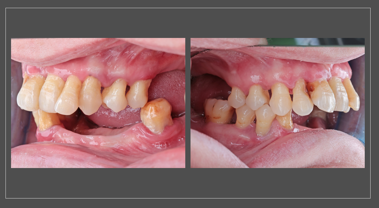 Intraoral views detailing the partial edentulism, severe chronic periodontitis, and occlusal 