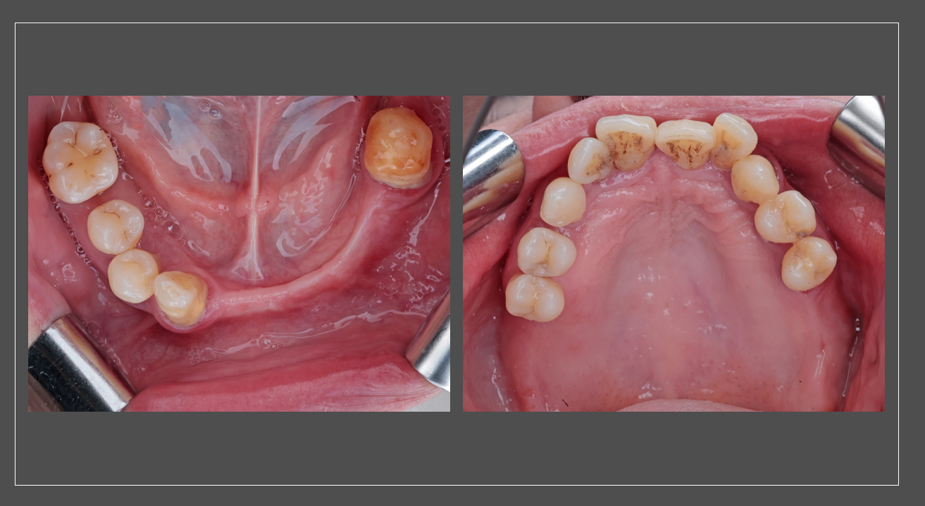 Intraoral views detailing the partial edentulism, severe chronic periodontitis, and occlusal 
