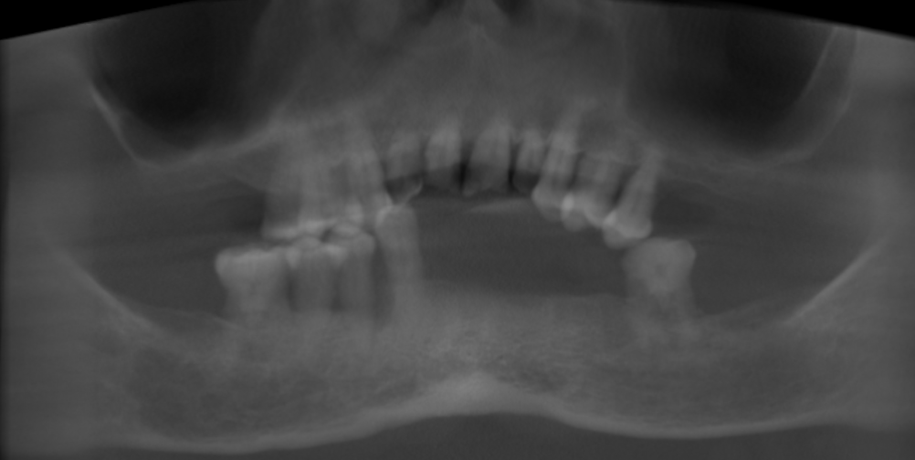 Pre-operative panoramic radiograph confirming severe generalized bone resorption.