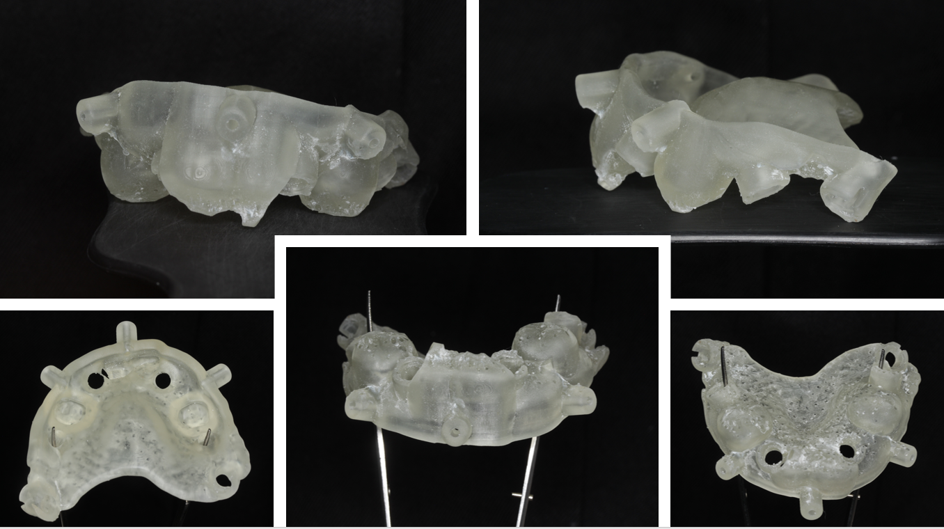 3D‑printed B.A.T. surgical guide physical models for guided maxillary dental implant placement