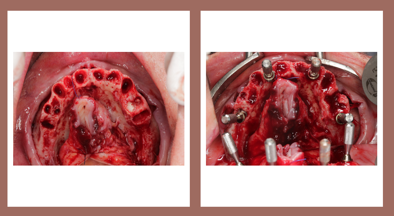 Post-placement intraoral views showing the distribution of four conventional and two pterygoid implants in the maxilla
