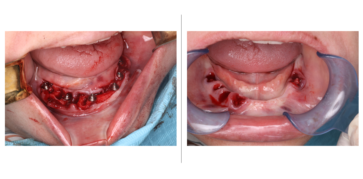 Post‑insertion intraoral views of maxillary pterygoid implants and mandibular All‑on‑6 dental implants