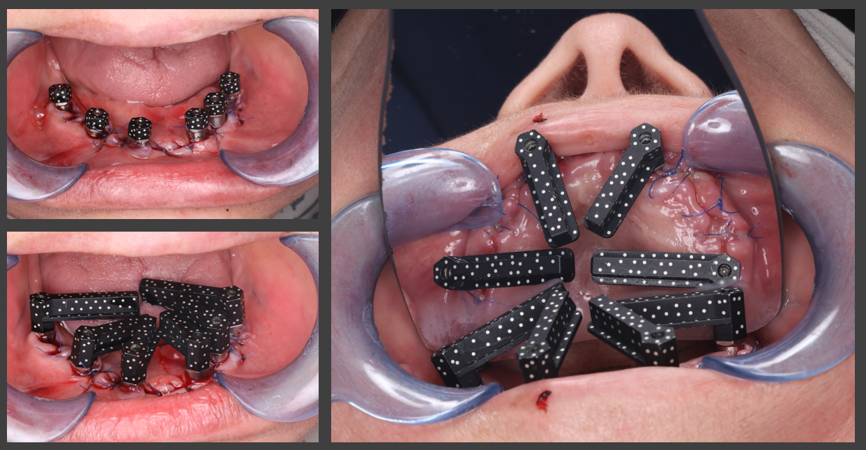 Intraoral clinical photos with photogrammetry scan bodies mounted on maxillary and mandibular dental implants for digital data acquisition