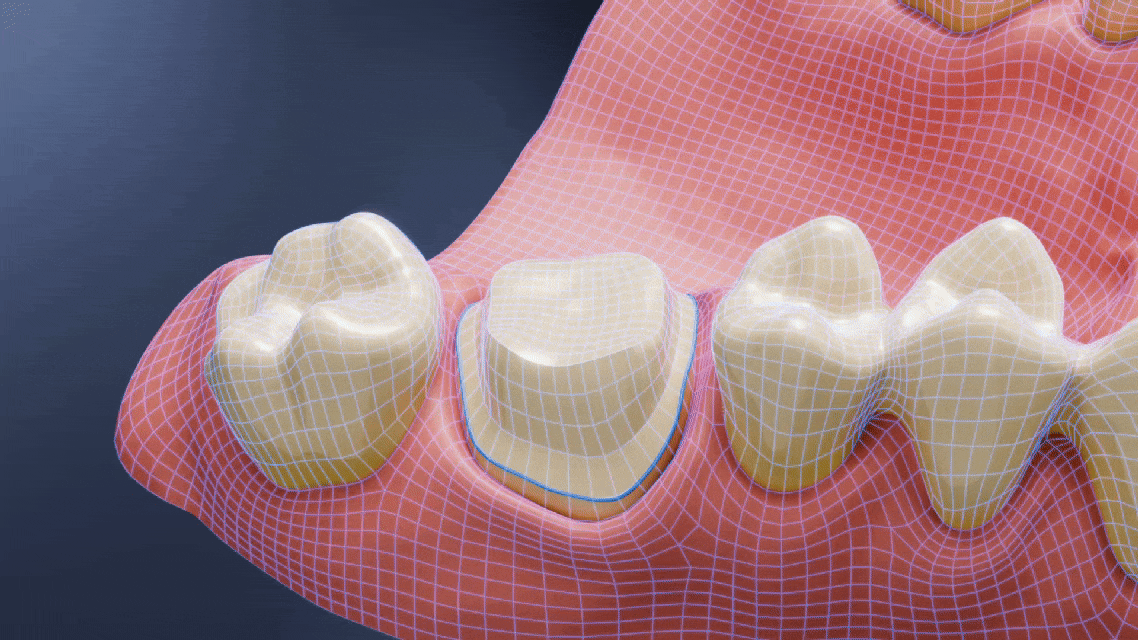 AI Design denture