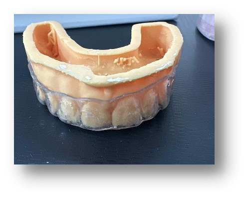 conventional splint 1