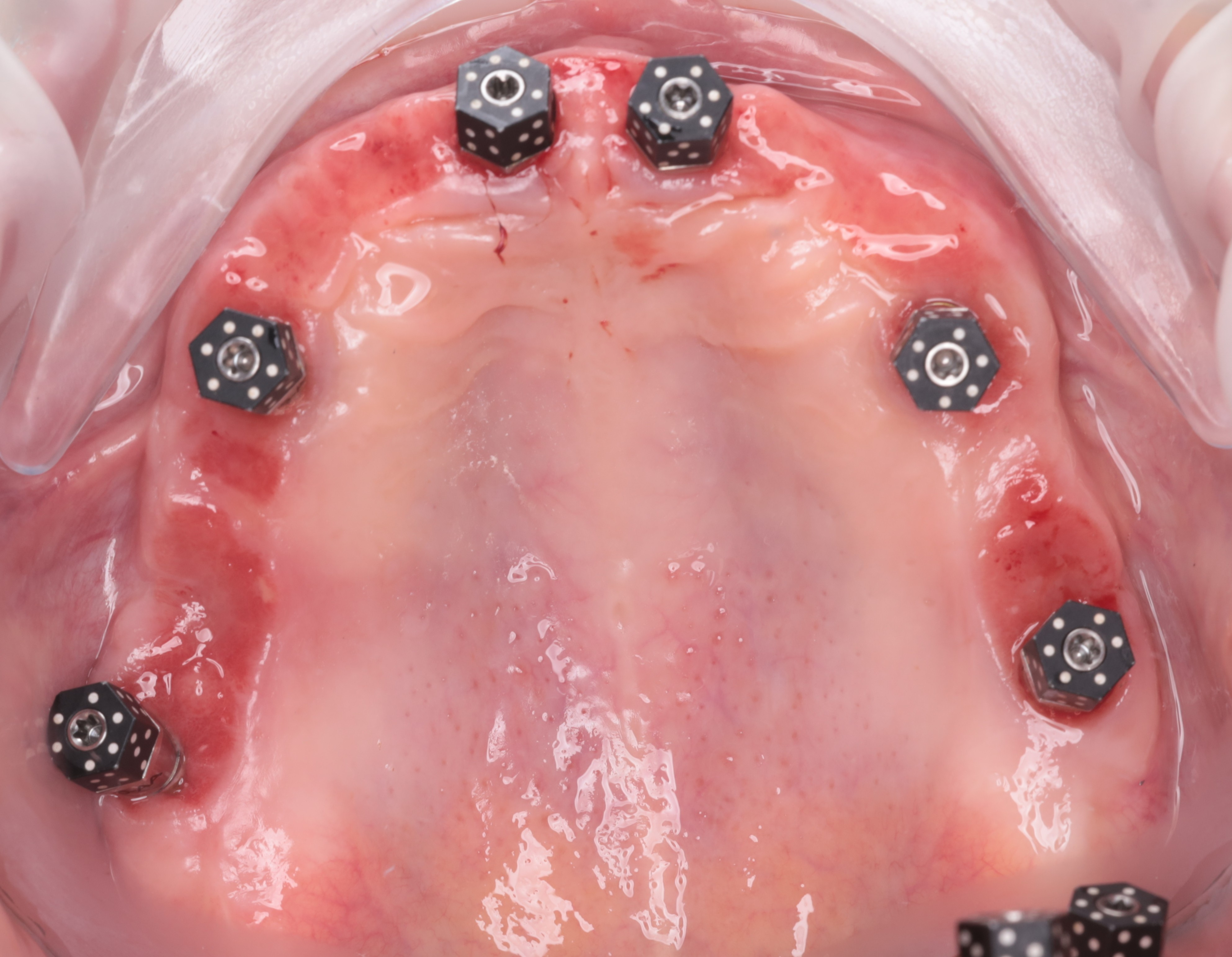 日期上颌扫描帽