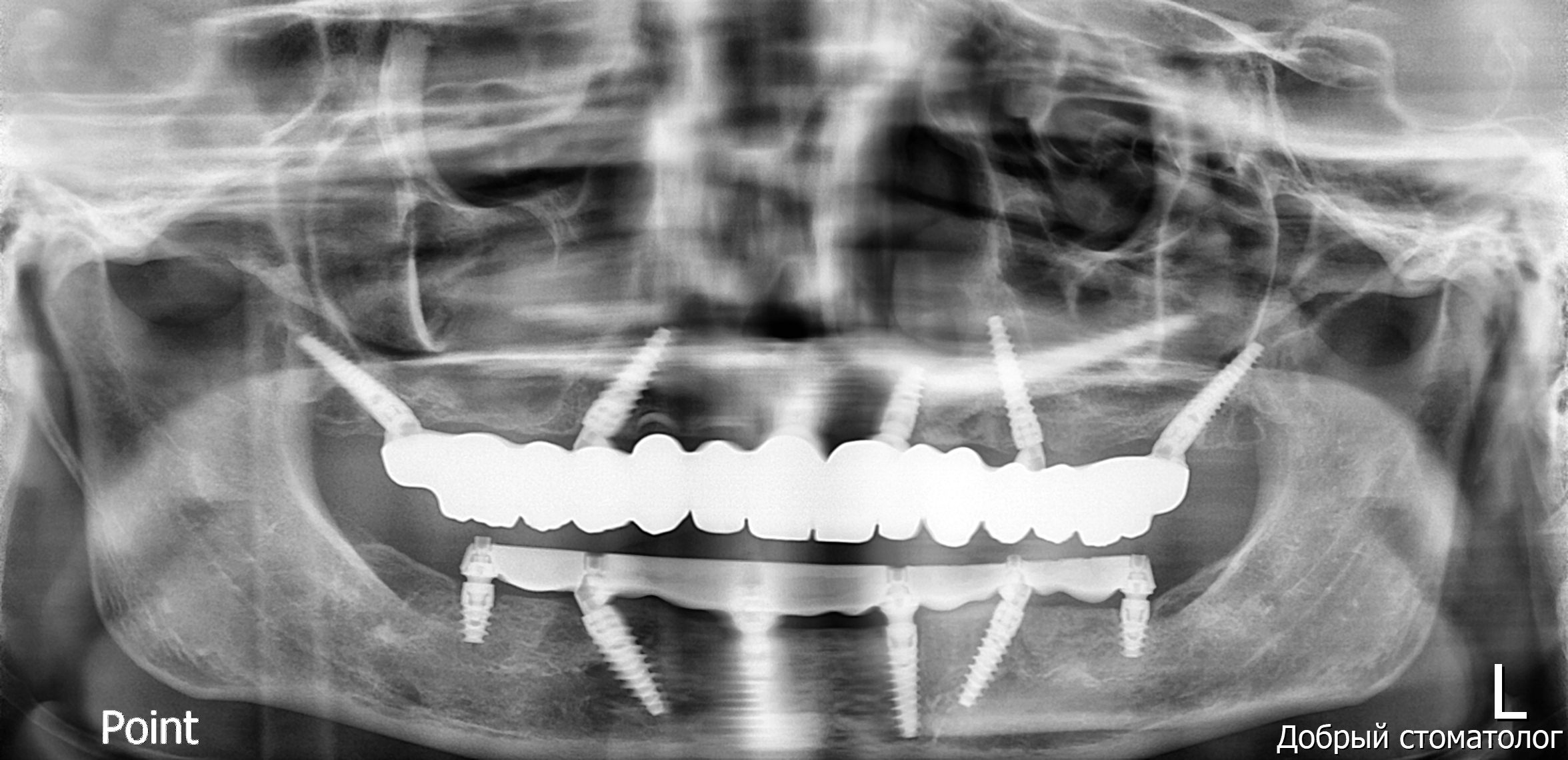 最终义齿影像-2