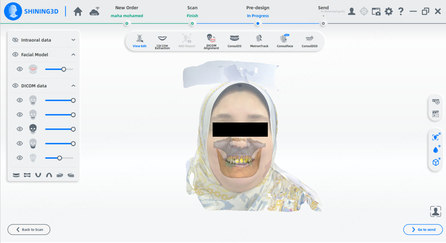 Shining 3D software interface integrating Metismile Facial Scanner facial model with intraoral dental scan data