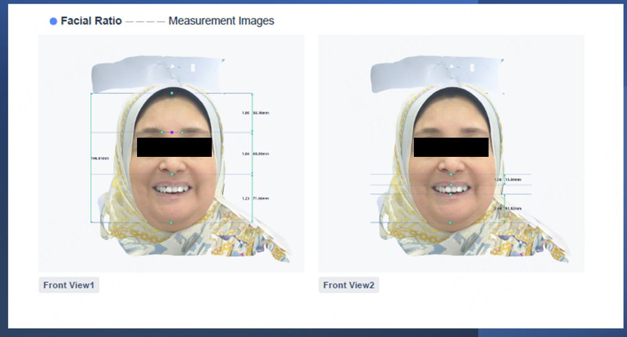 Shining 3D software screenshot performing facial proportion analysis using Metismile Facial Scanner captured patient data