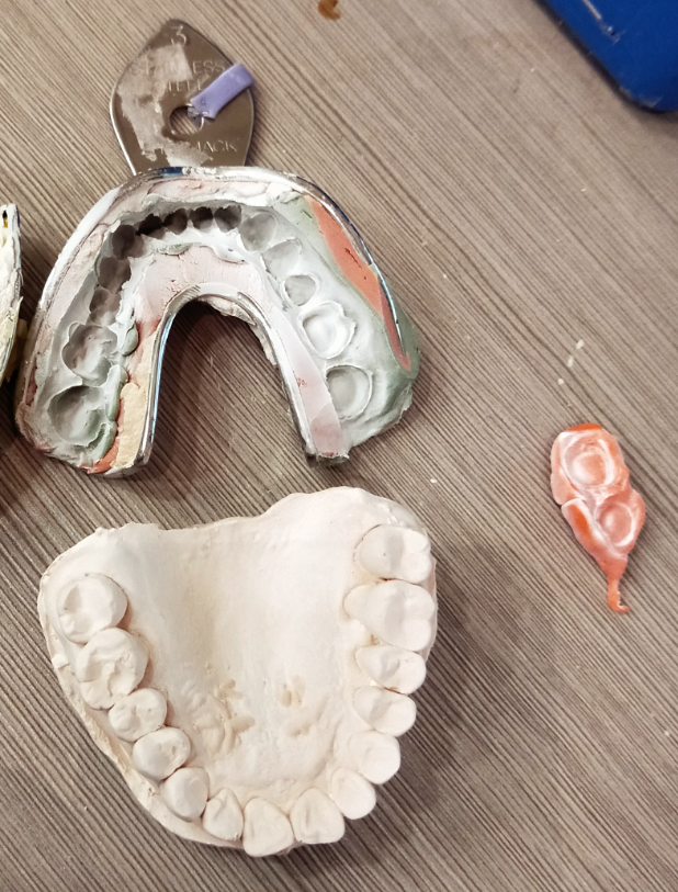 After the preparation was made, the dentist got the impression.