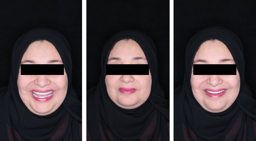 Post‑operative extraoral facial photographs after facially‑driven full‑mouth implant rehabilitation