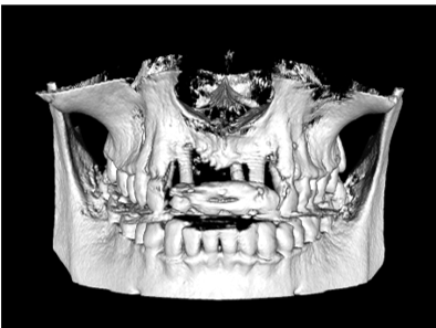 3D CBCT view of the maxilla showing anterior dental implants