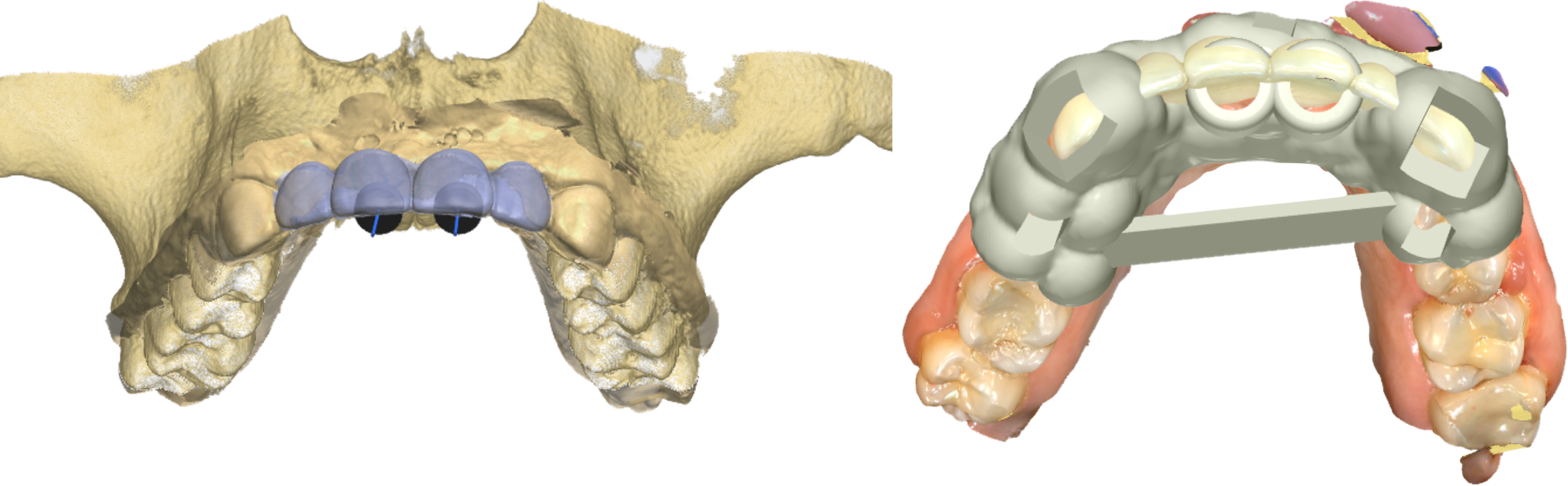 3D dental implant surgical planning showing implant positions and surgical guide design