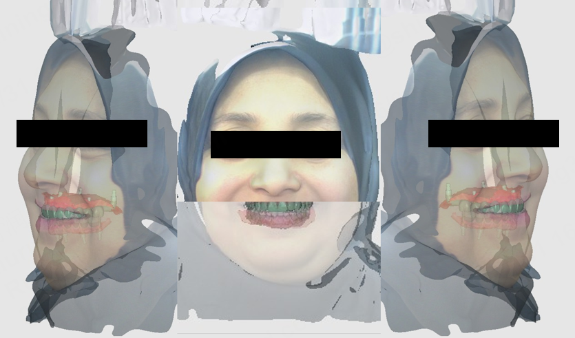 3D facial scan overlay with Exocad virtual prosthesis to validate smile arc and facial harmony