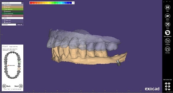 (6) Select teeth that should be detachable