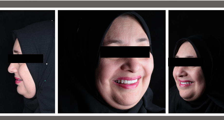 Post‑operative profile and oblique facial photos showing restored lower facial height and lip support from implant‑supported prostheses