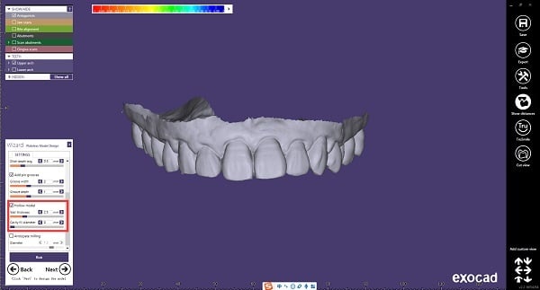 (8) Working model design , define the gingiva mask