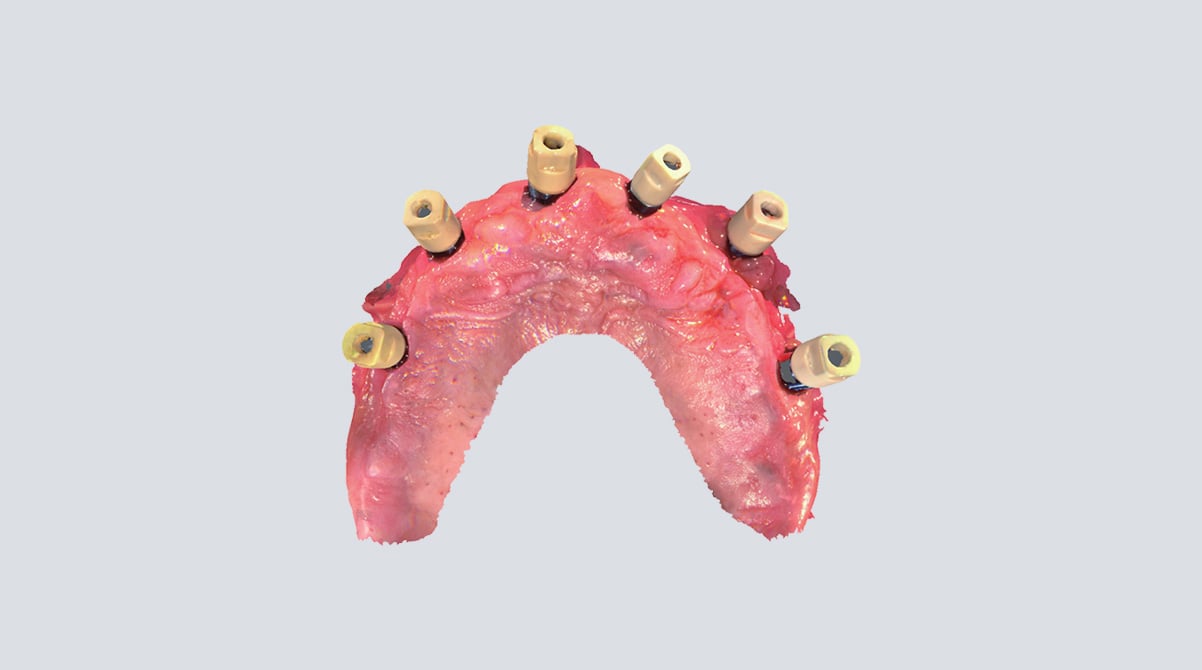 Digital implant workflow with Aoralscan 3