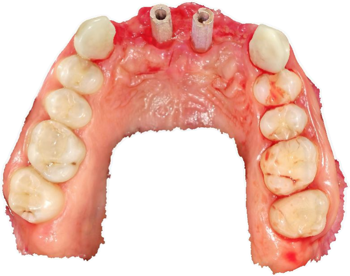 Aoralscan Elite intraoral scan showing implant-level scan markers in the maxillary arch-1