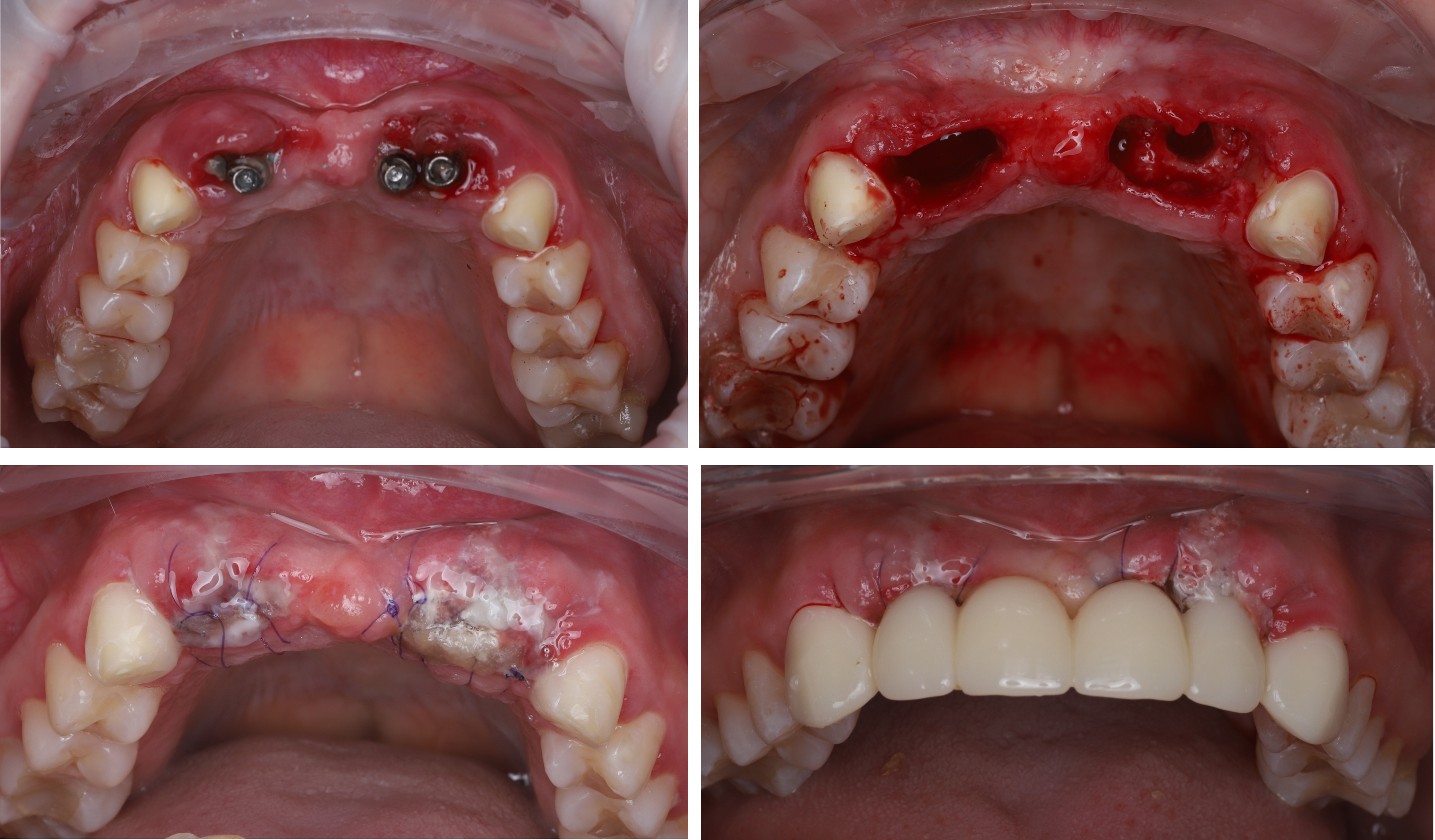 Clinical images showing failed dental implant removal, bone grafting for ridge preservation, and temporary fixed prosthesis placement