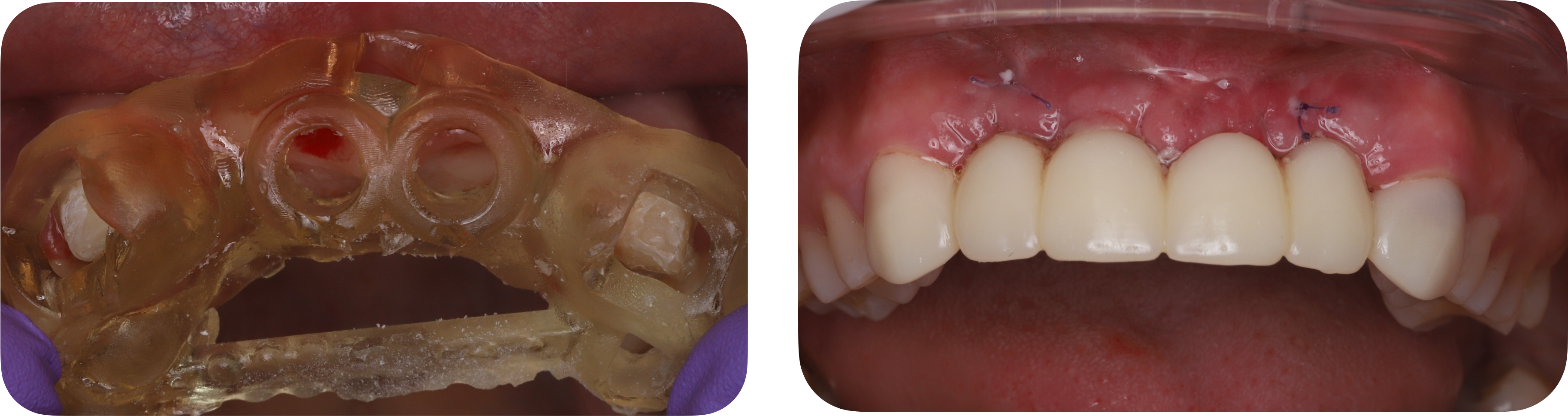 Dental implant surgical guide placement and postoperative temporary fixed prosthesis