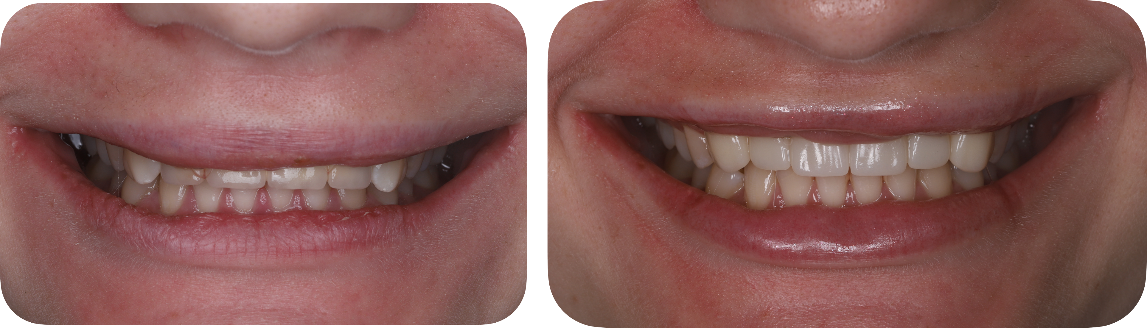 Final smile views showing the implant-supported restoration integrated with the natural dentition