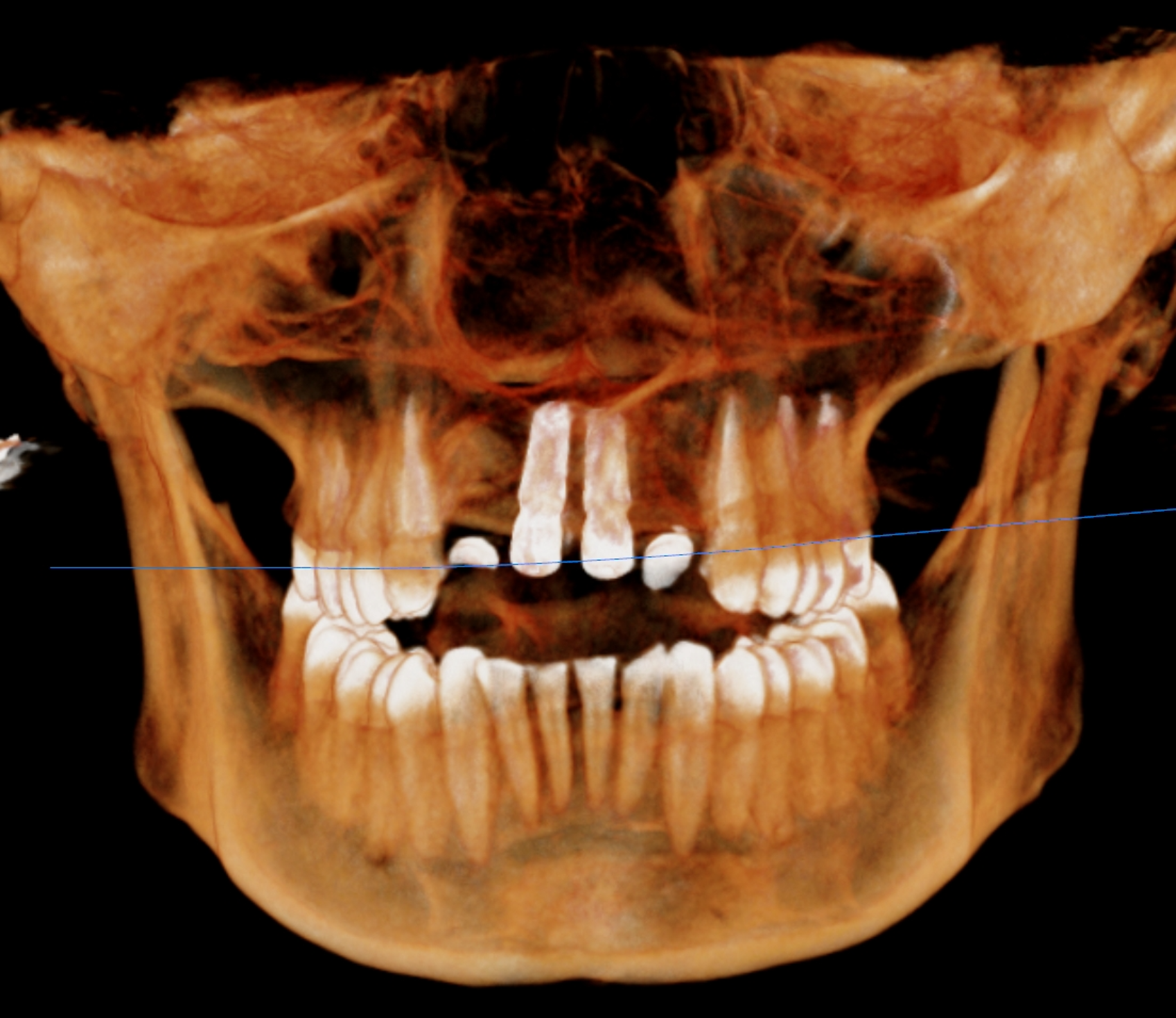 Follow-up 3D CT view1-1