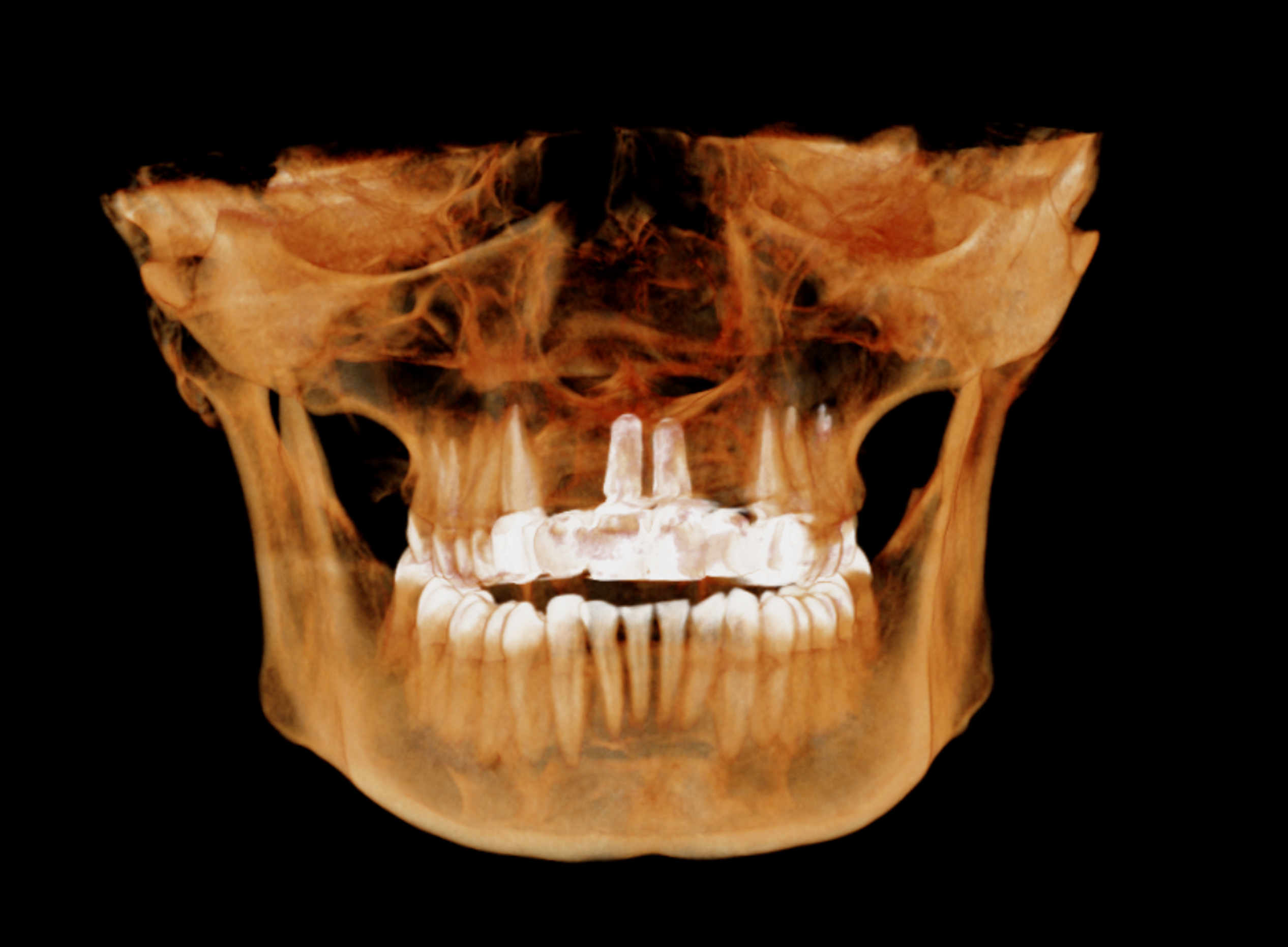 Follow-up 3D CT view2-1