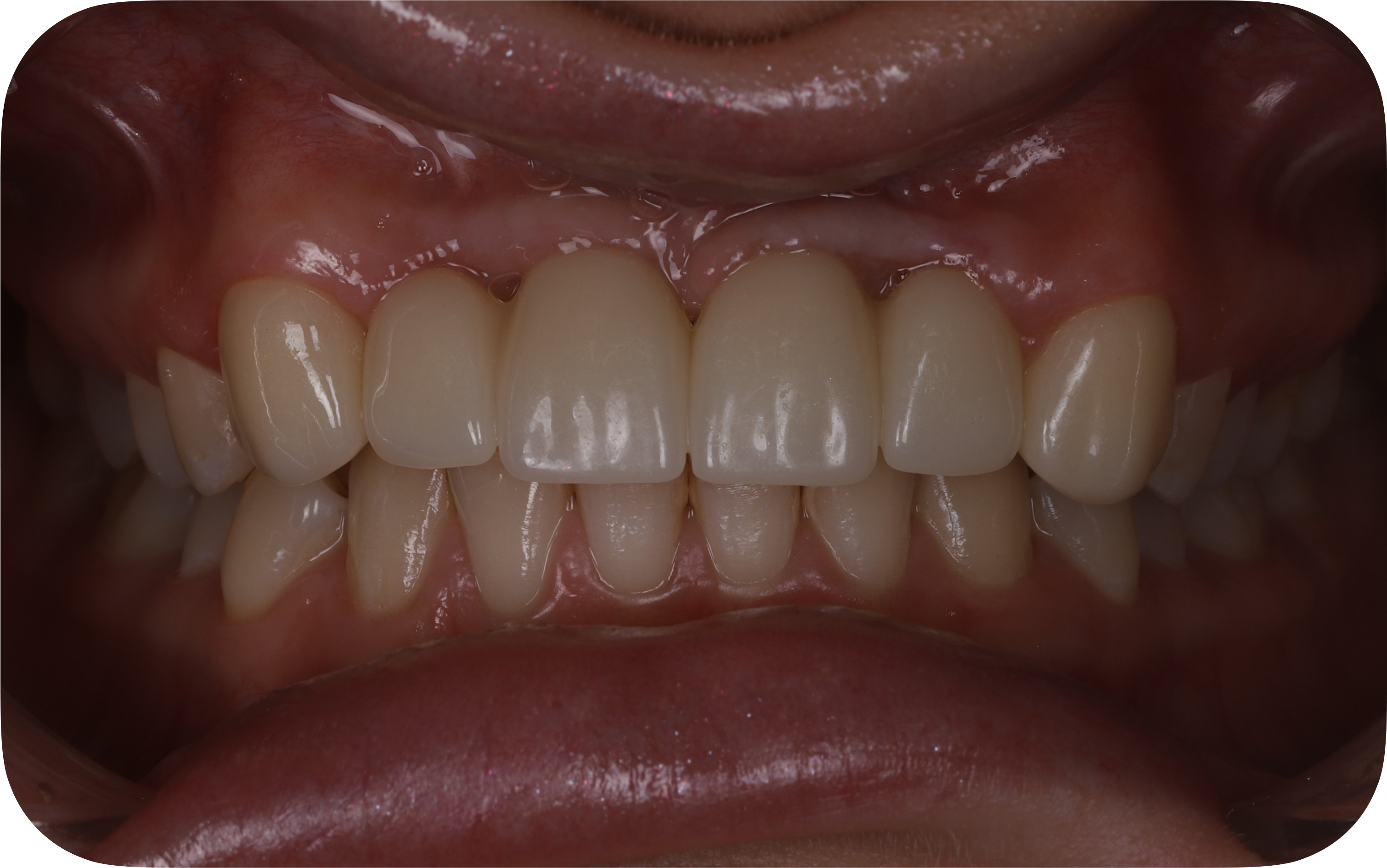 Intraoral view of the final implant-supported prosthesis in the anterior maxilla