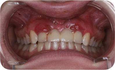 Intraoral view of the upper anterior implant region with gingival inflammation