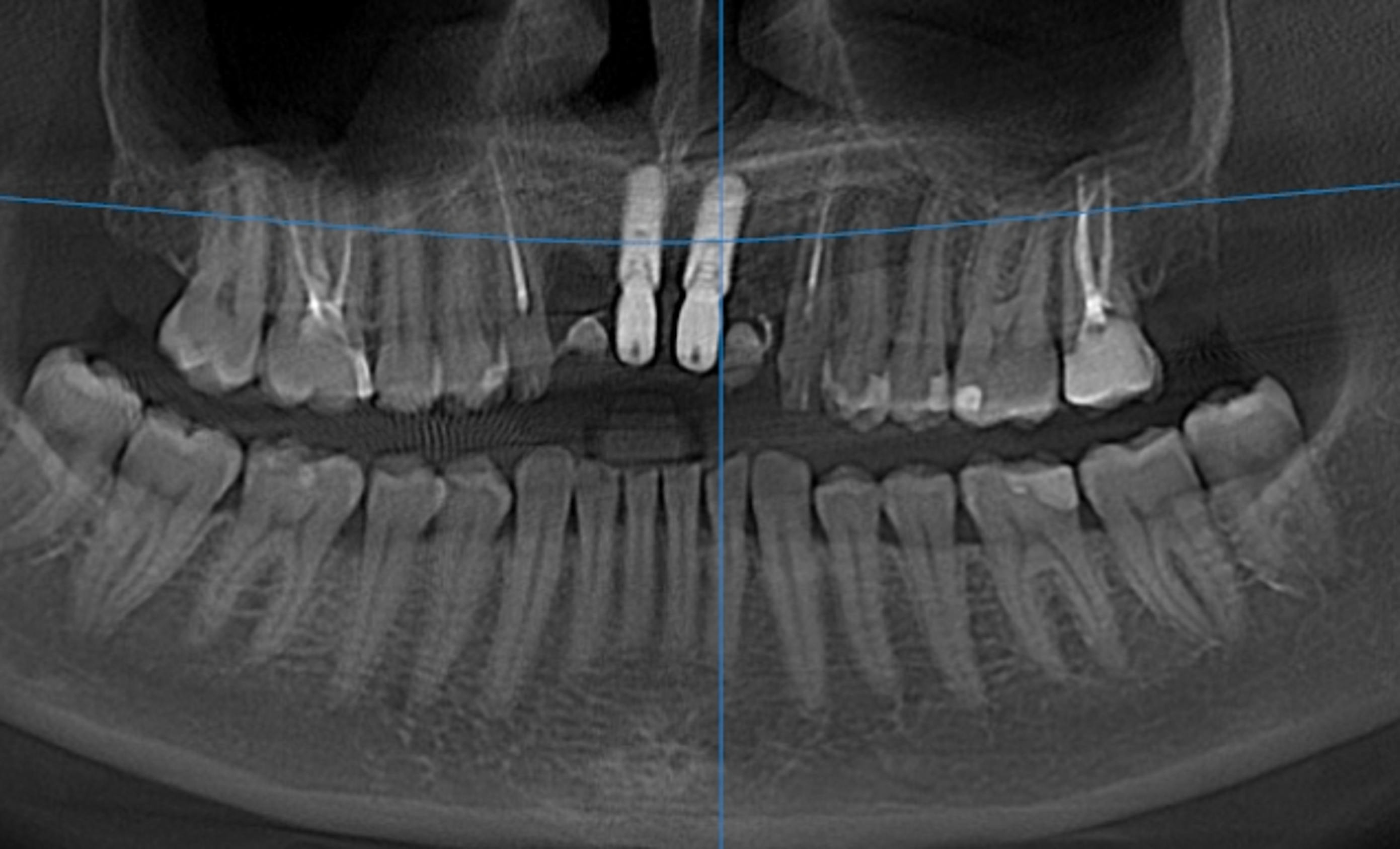 Panoramic dental radiograph showing two implants in the maxillary central incisor region