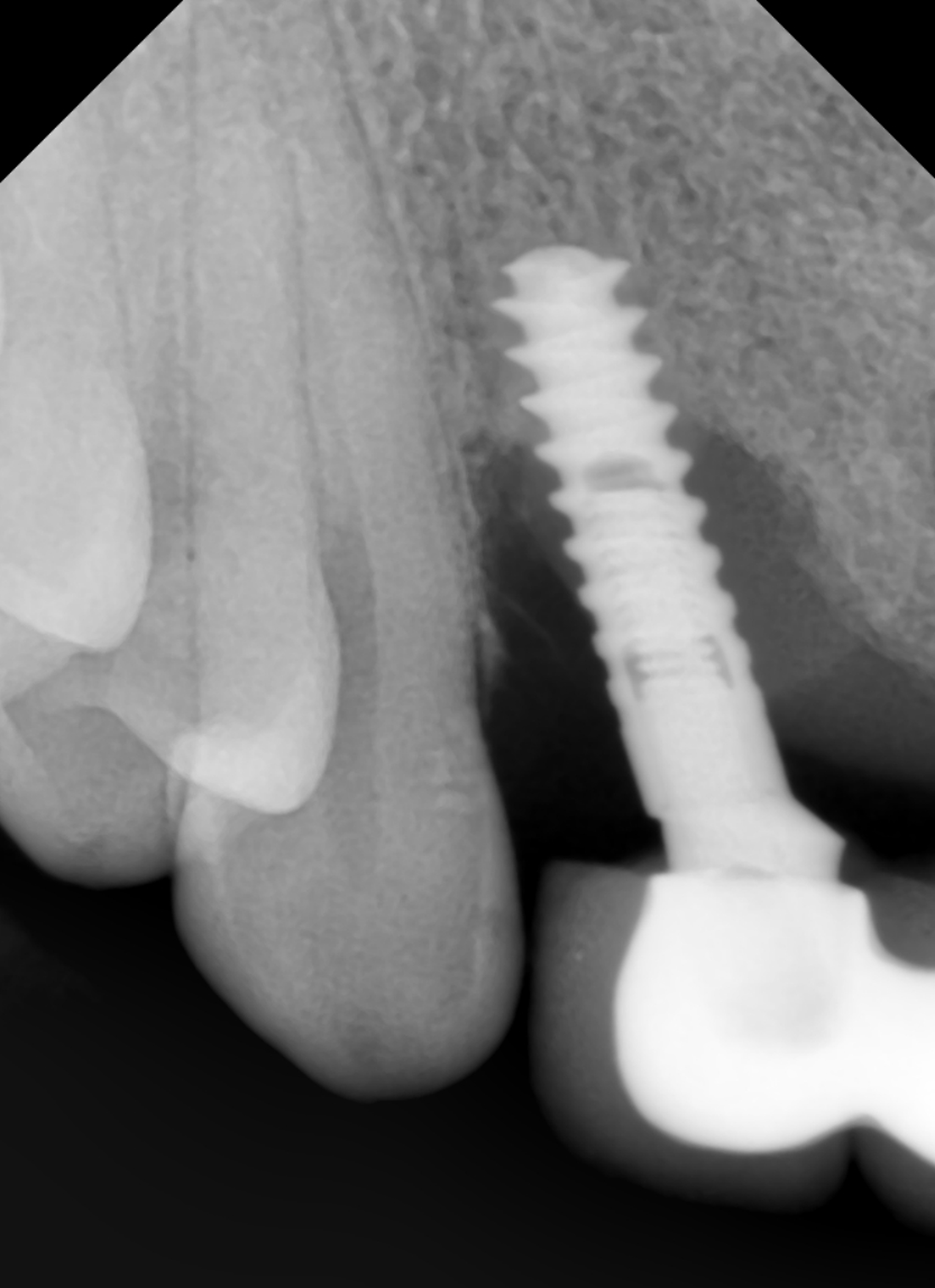 Periapical radiograph showing peri-implant bone loss around a maxillary anterior dental implant