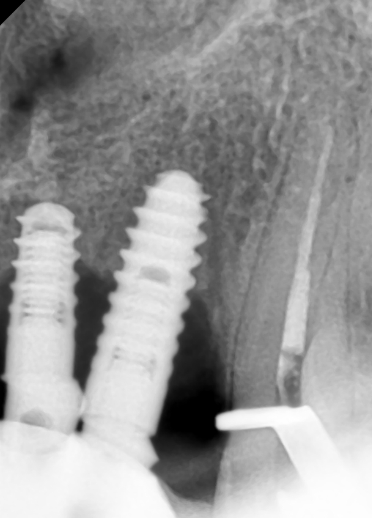 Periapical radiograph showing peri-implant bone loss around two maxillary anterior dental implants