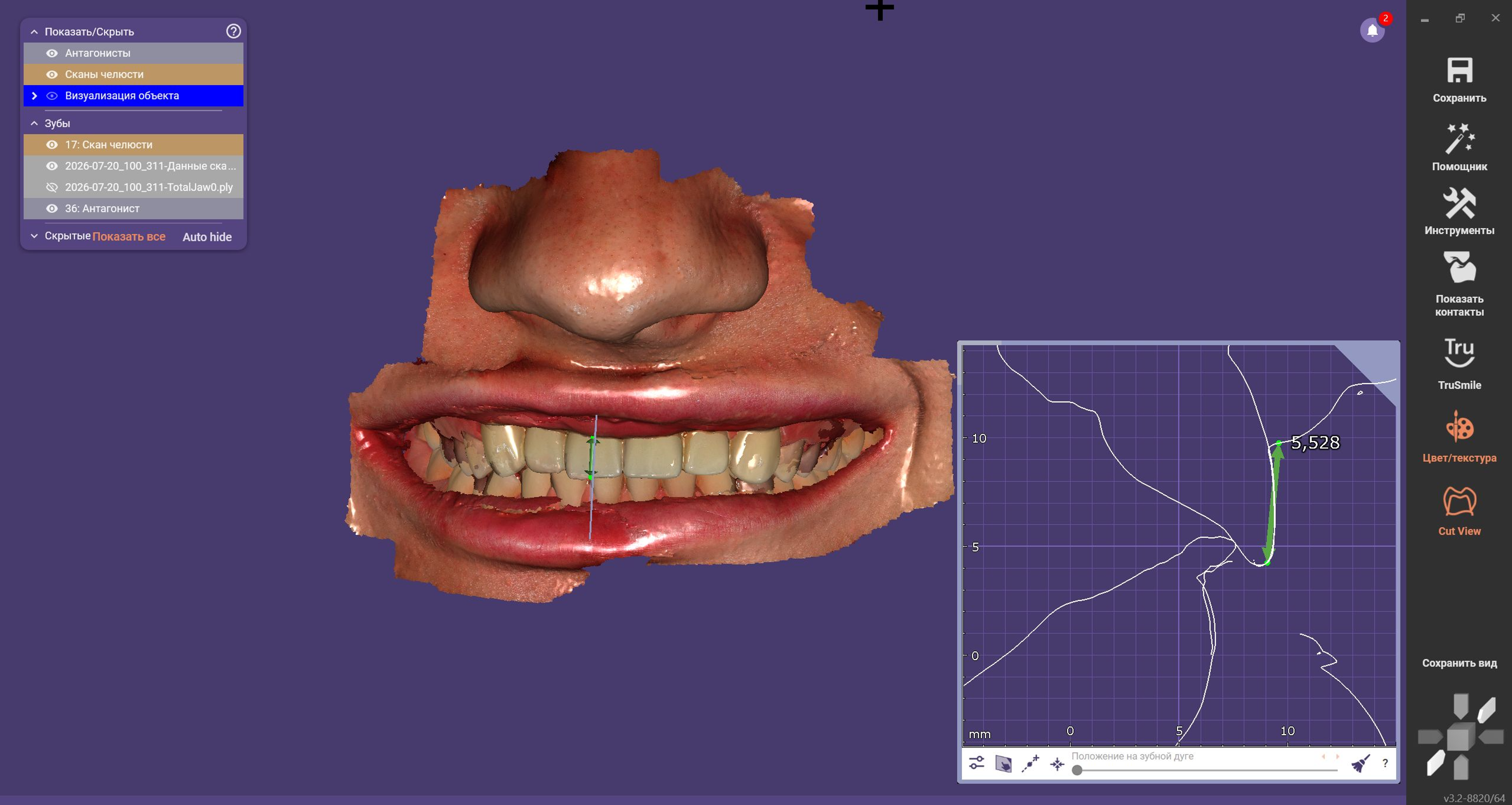 exocad CAD design showing aligned facial scan and dynamic jaw movement data for implant-supported crowns