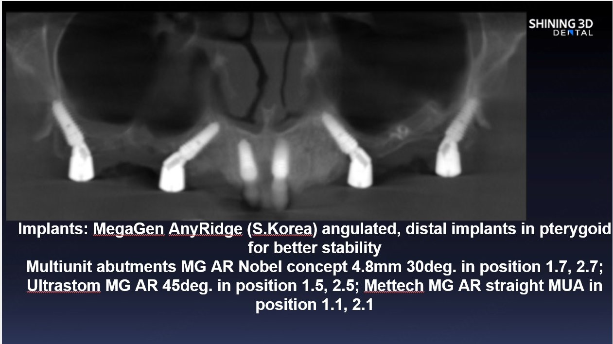 implants