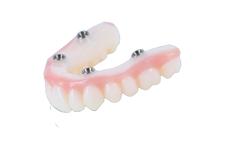 All-on-X impression 3D