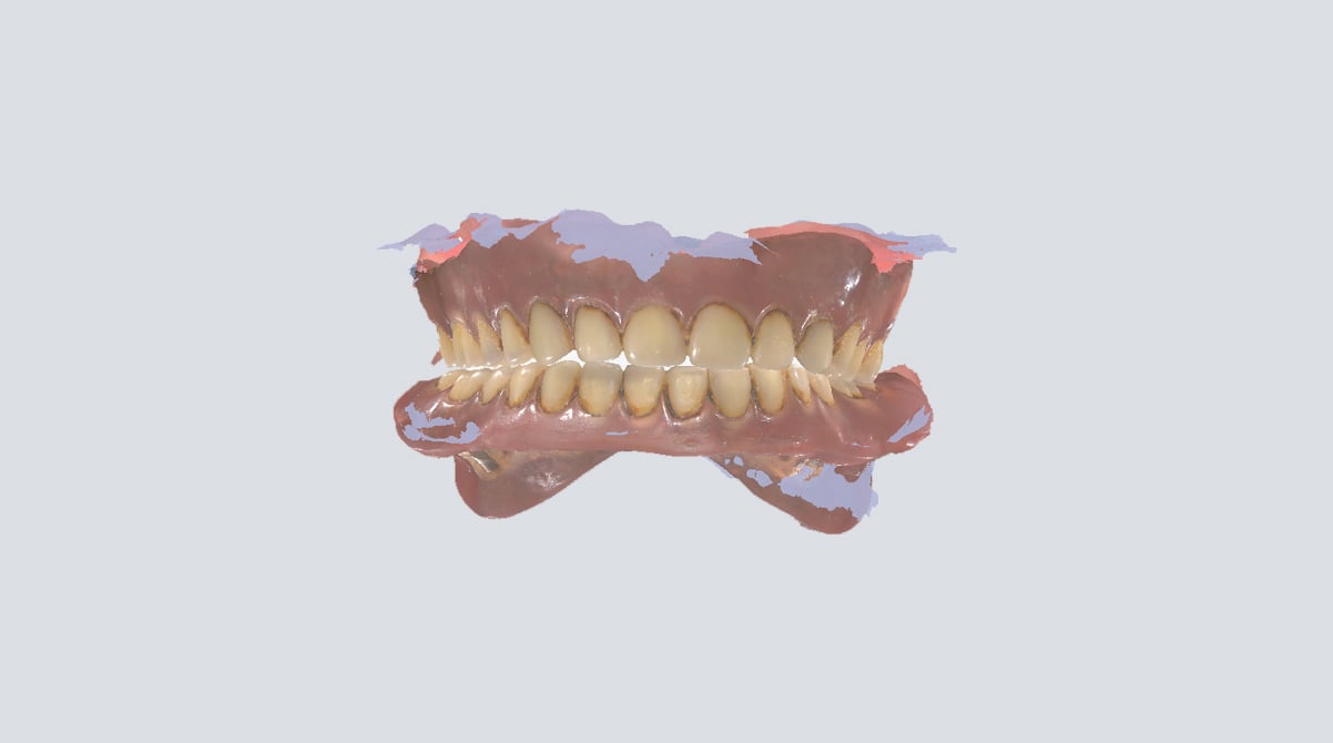 digital removable denture workflow with Aoralscan 3