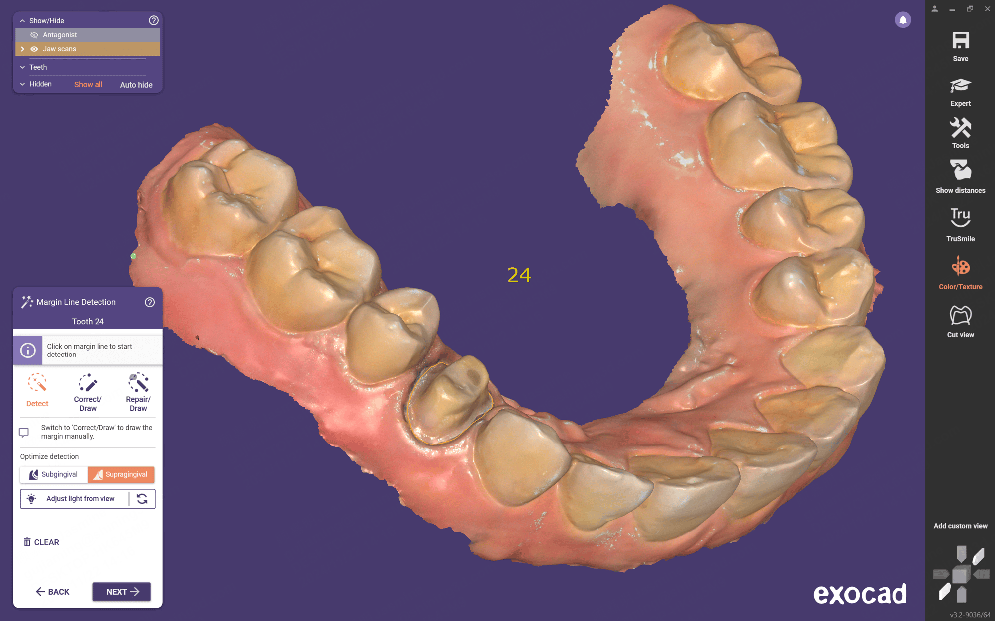 Aoralscan 3口腔内スキャナー スキャンデータ Exocadへの直接エクスポート