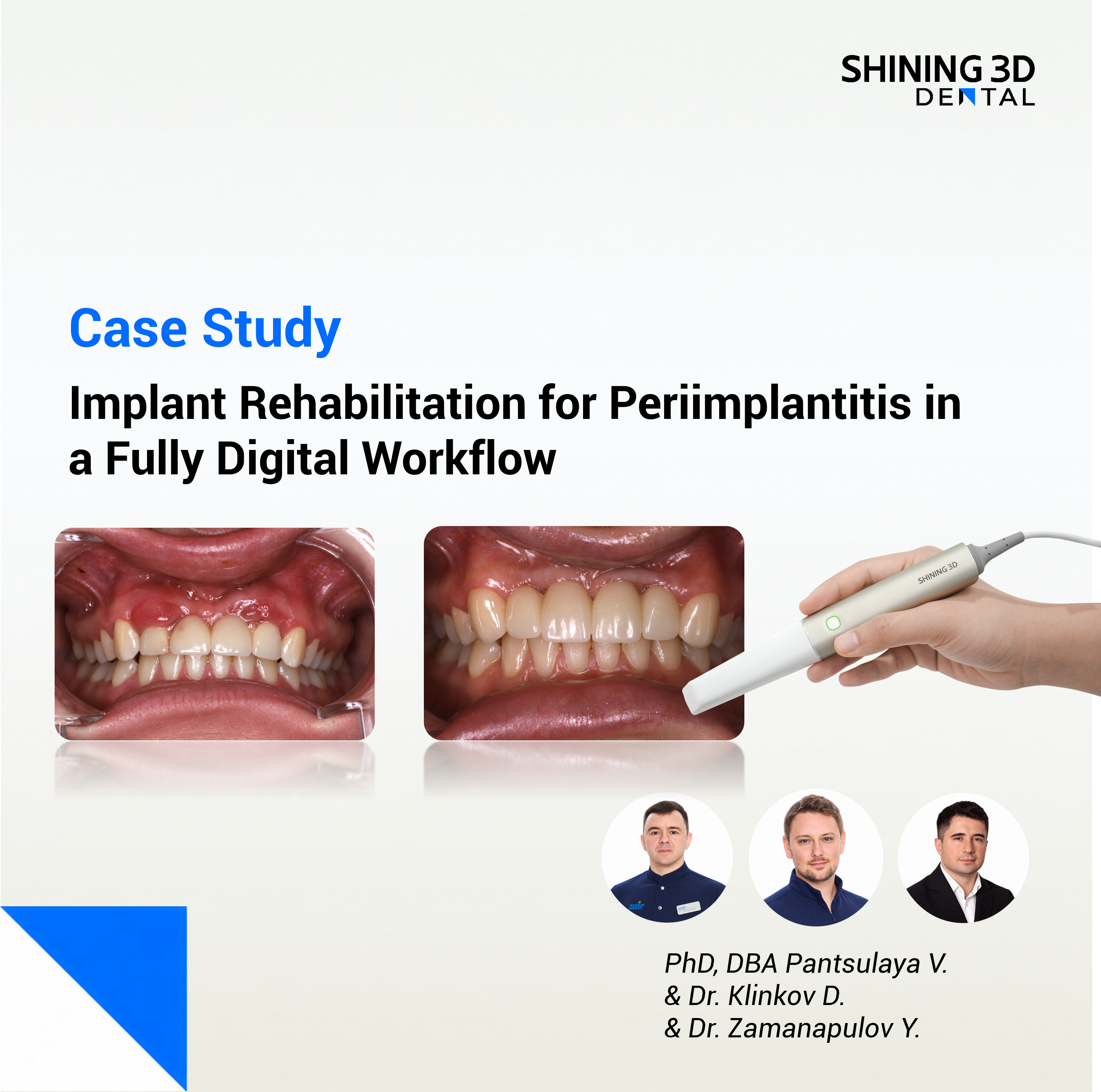 Implant Rehabilitation for Periimplantitis in a Fully Digital Workflow