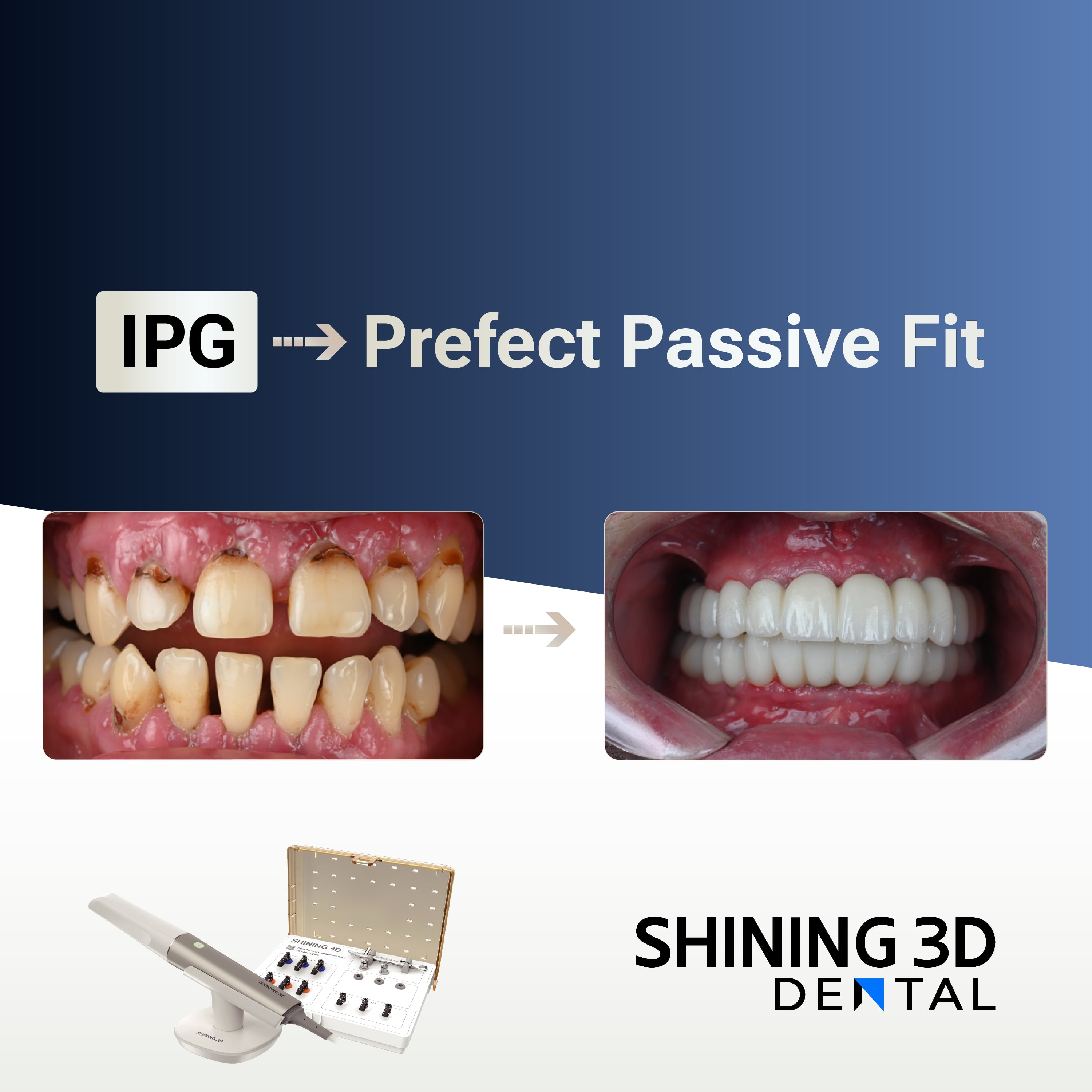 All-on-6 Immediate Loading for Severe Periodontitis in a Fully Digital Workflow（IPG）