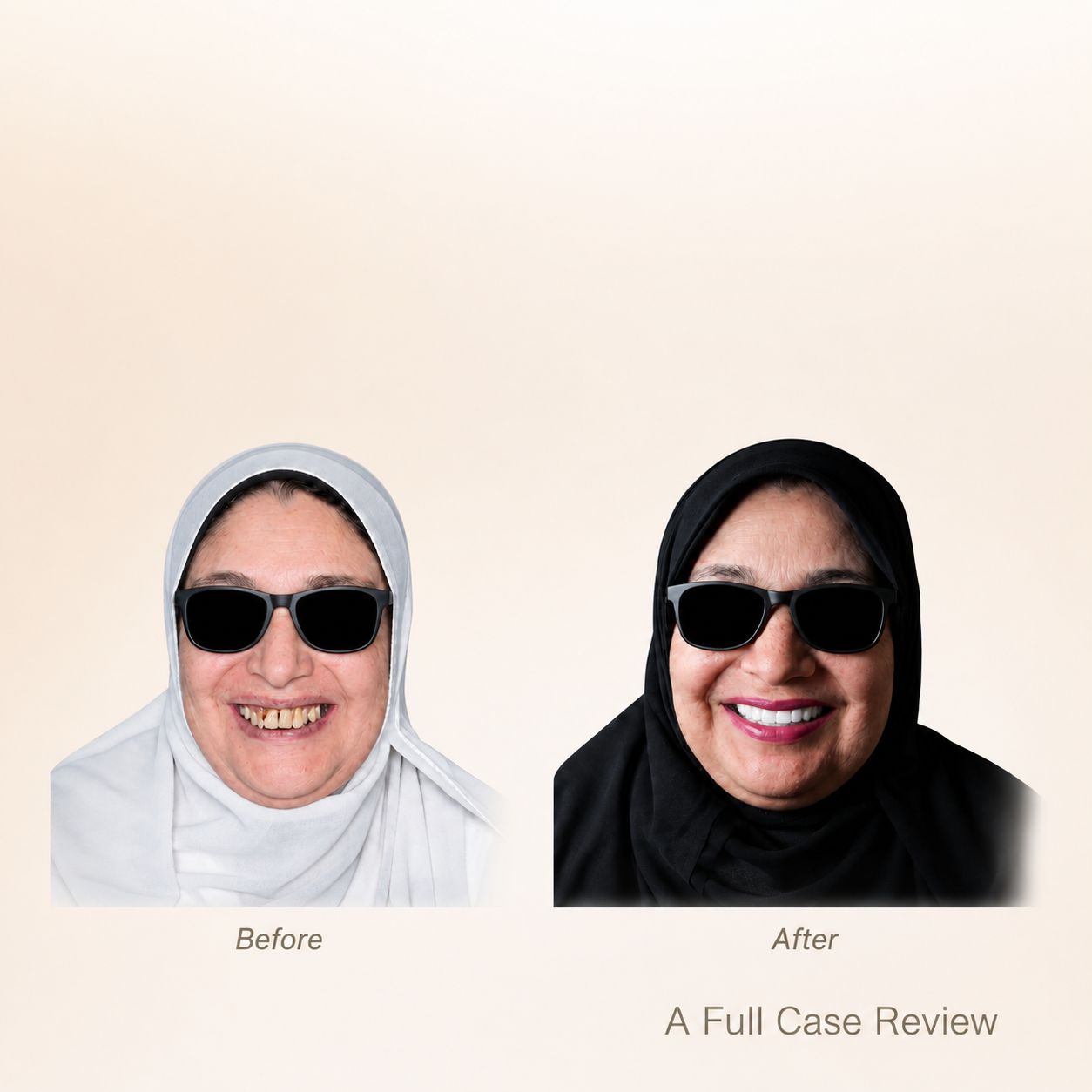 A Case Report: Harmoniously Facially Driven Implant Full Mouth Rehabilitation with Bite Deprogramming