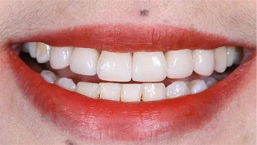  All-ceramic veneer restoration