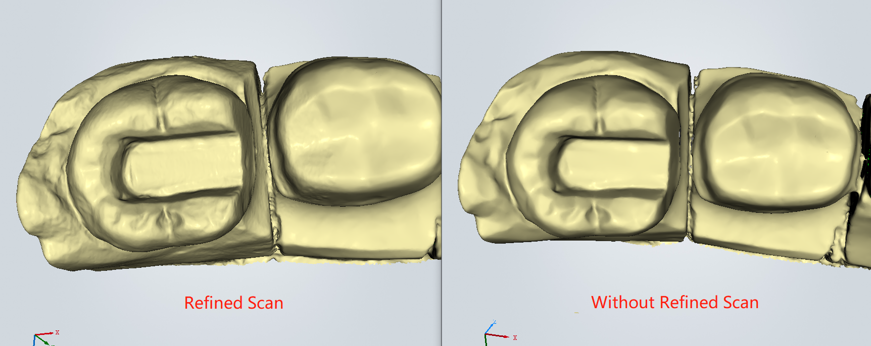 3D Scanning for IOS InlayOnlay Section