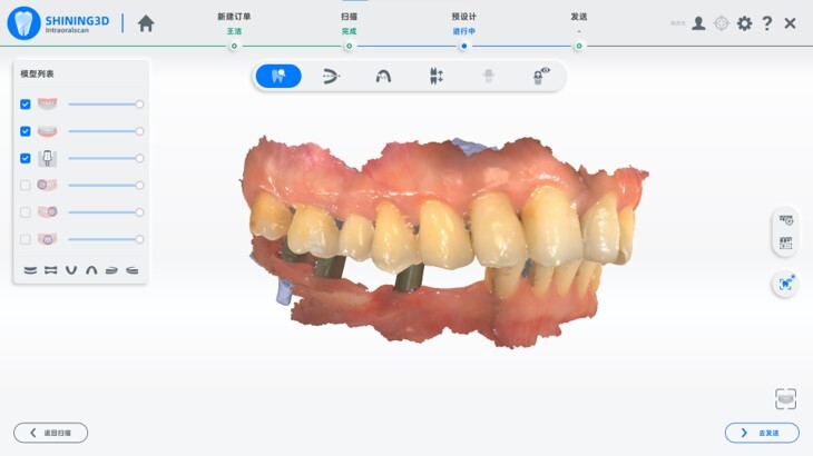 A Unilateral Distal Extension Edentulous Case Restored by Multiple Implants Using a Digital Workflow