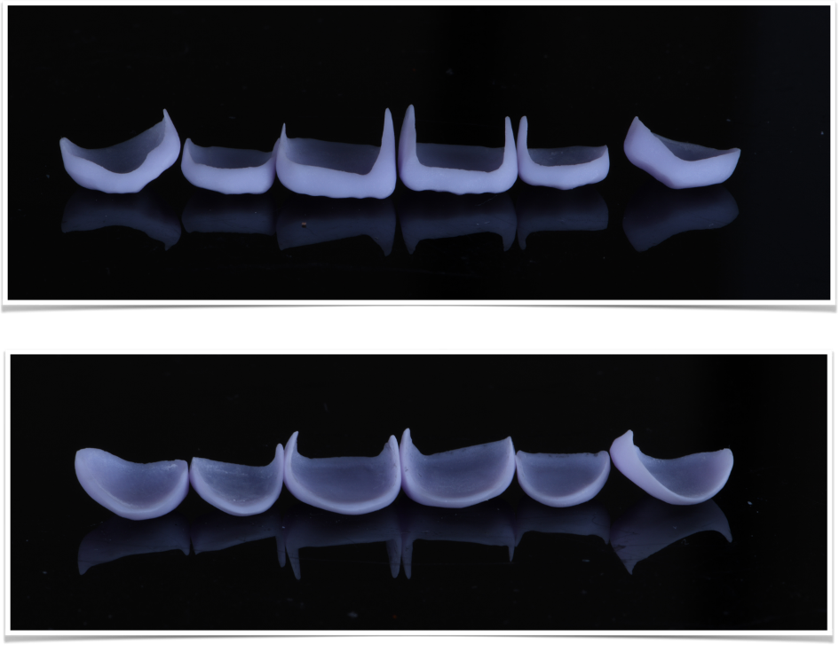 Aesthetic Porcelain Veneers 2