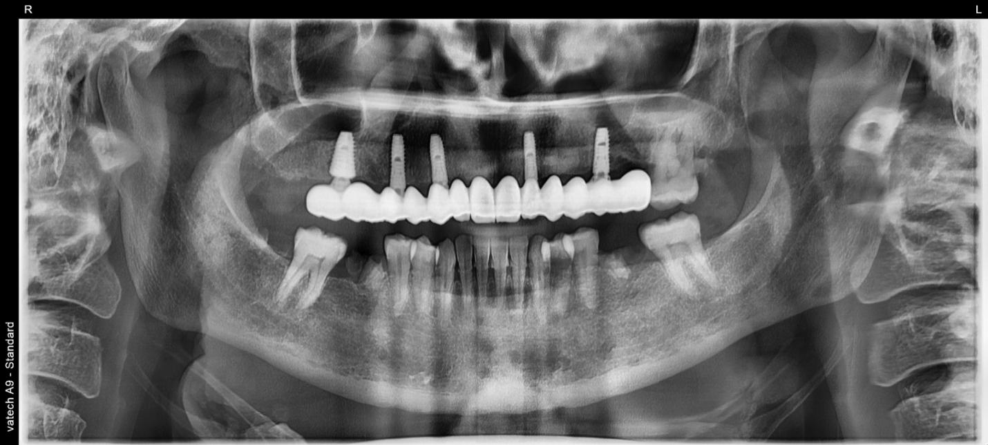 All-on-Five Implant Case Using Aoralscan Elite and MetiSmile from Shining 3D