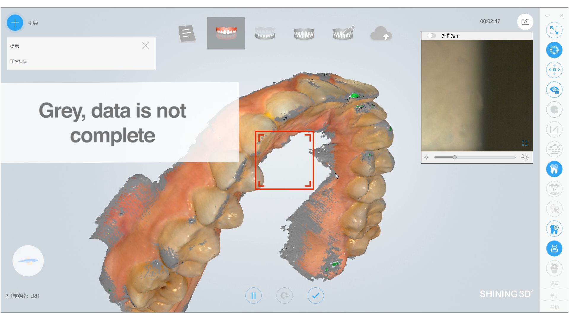 AoralScan- Get Complete Scan Data with Tooth Color Function